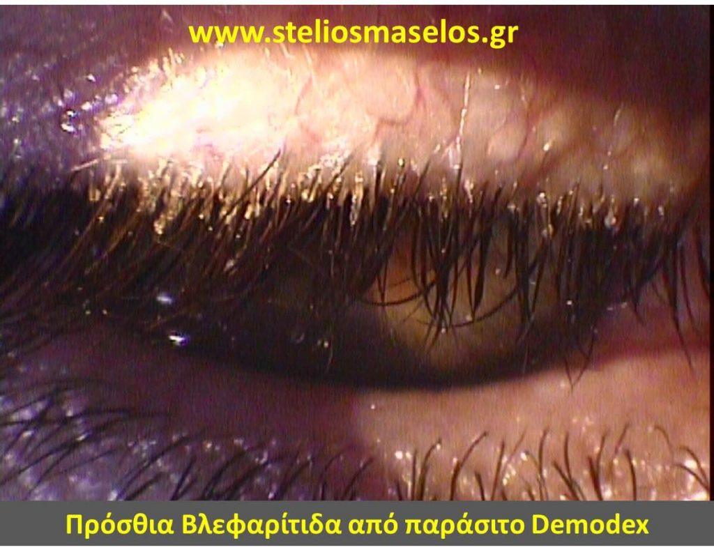 Πρόσθια βλεφαρίτιδα από παράσιτο demodex