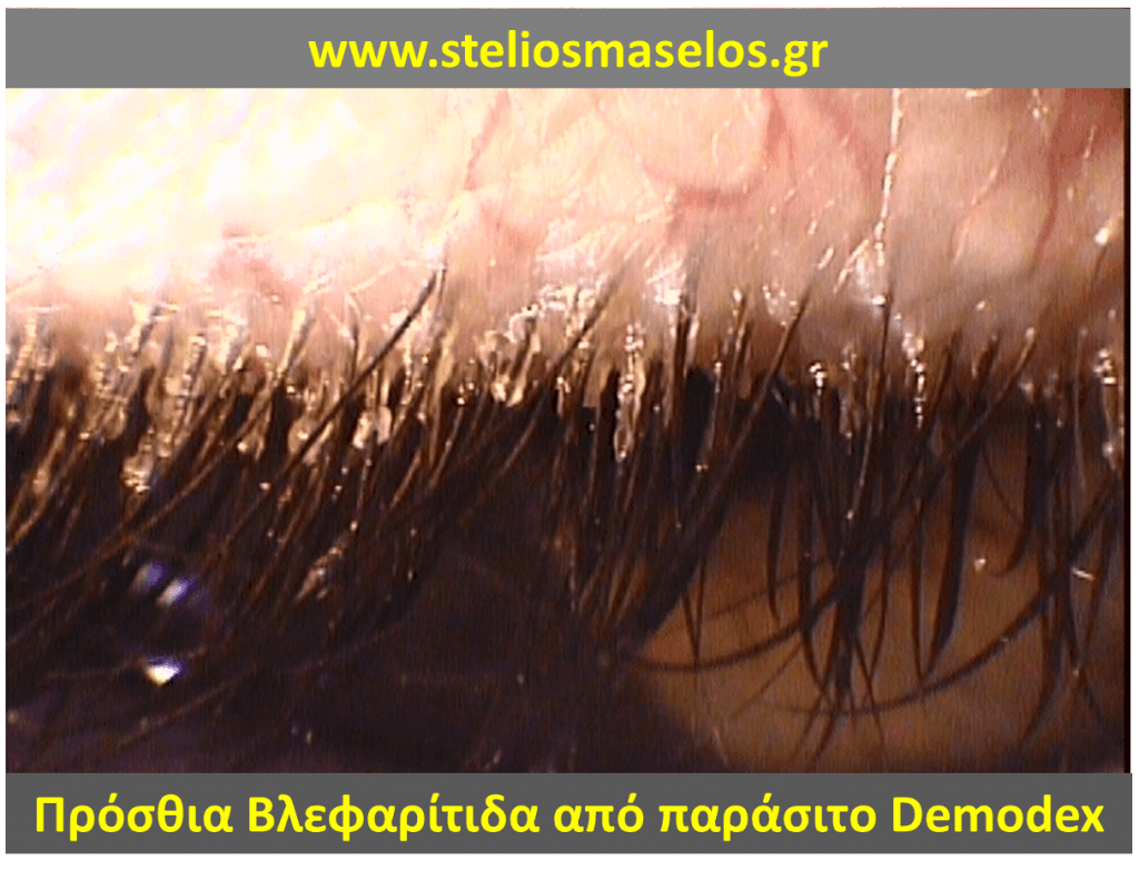 Πρόσθια βλεφαρίτιδα από παράσιτο demodex