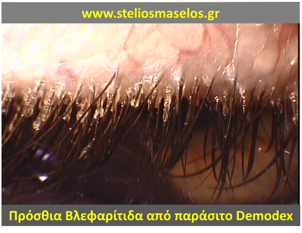 Πρόσθια βλεφαρίτιδα από παράσιτο demodex