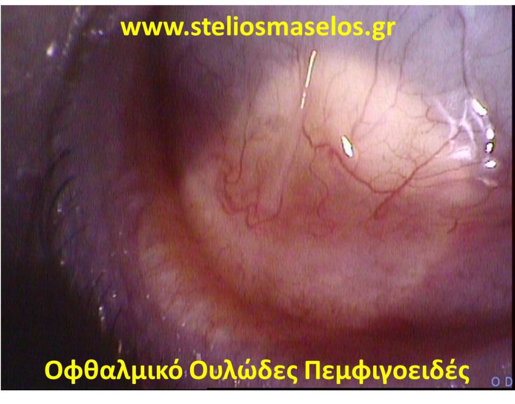 ΟΦΘΑΛΜΙΚΟ ΟΥΛΩΔΕΣ ΠΕΜΦΙΓΟΕΙΔΕΣ