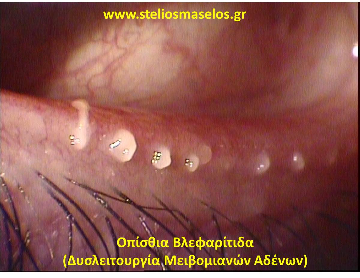 Οπίσθια Βλεφαρίτιδα (Δυσλειτουργία Μειβομιανών Αδένων)