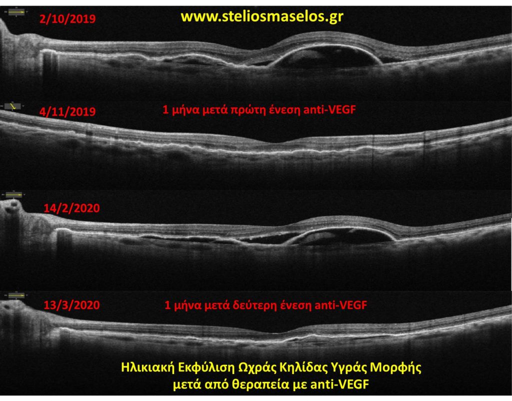 Ηλικιακή Εκφύλιση Ωχράς Κηλίδας Υγράς Μορφής μετά από θεραπεία με anti-VEGF