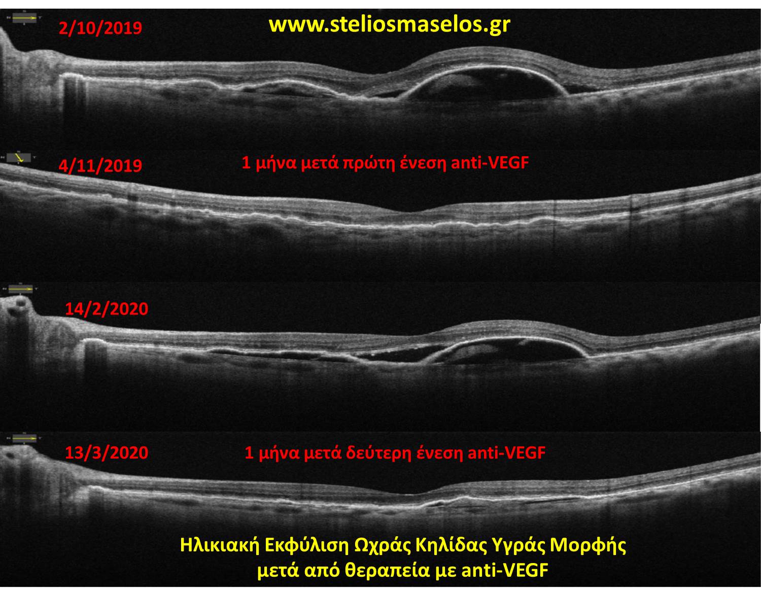 Ηλικιακή Εκφύλιση Ωχράς Κηλίδας Υγράς Μορφής μετά από θεραπεία με anti-VEGF