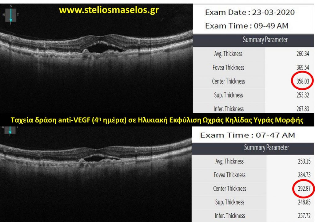 Ταχεία δράση anti-VEGF (4η ημέρα) σε Ηλικιακή Εκφύλιση Ωχράς Κηλίδας Υγράς Μορφής