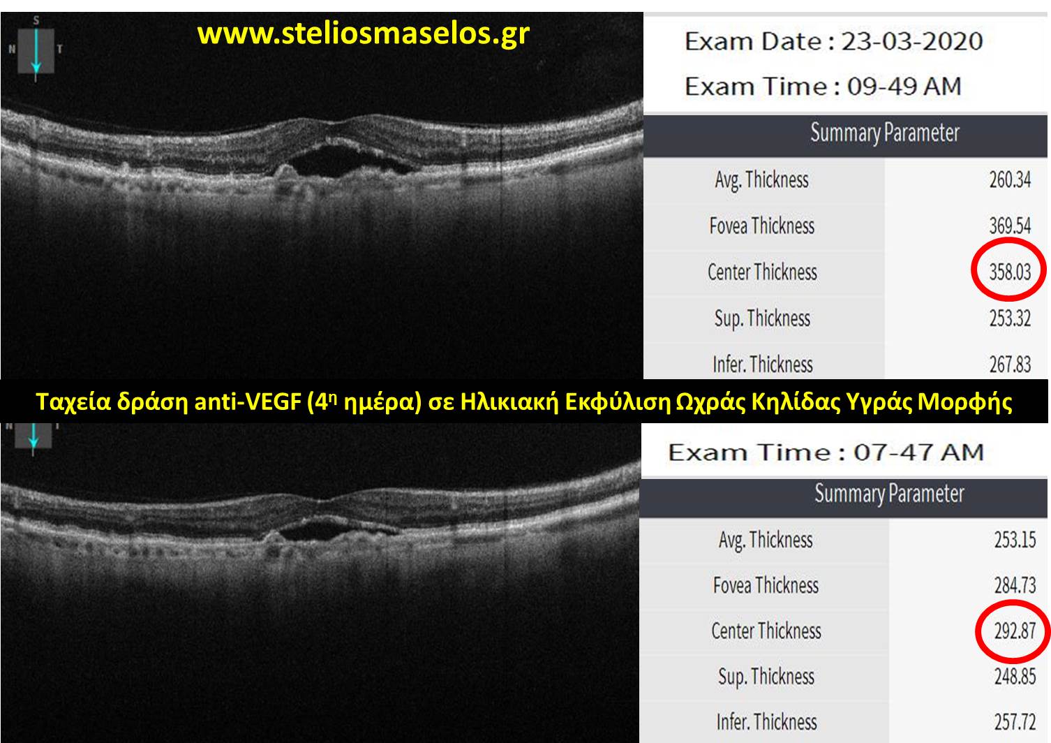 Ταχεία δράση anti-VEGF (4η ημέρα) σε Ηλικιακή Εκφύλιση Ωχράς Κηλίδας Υγράς Μορφής