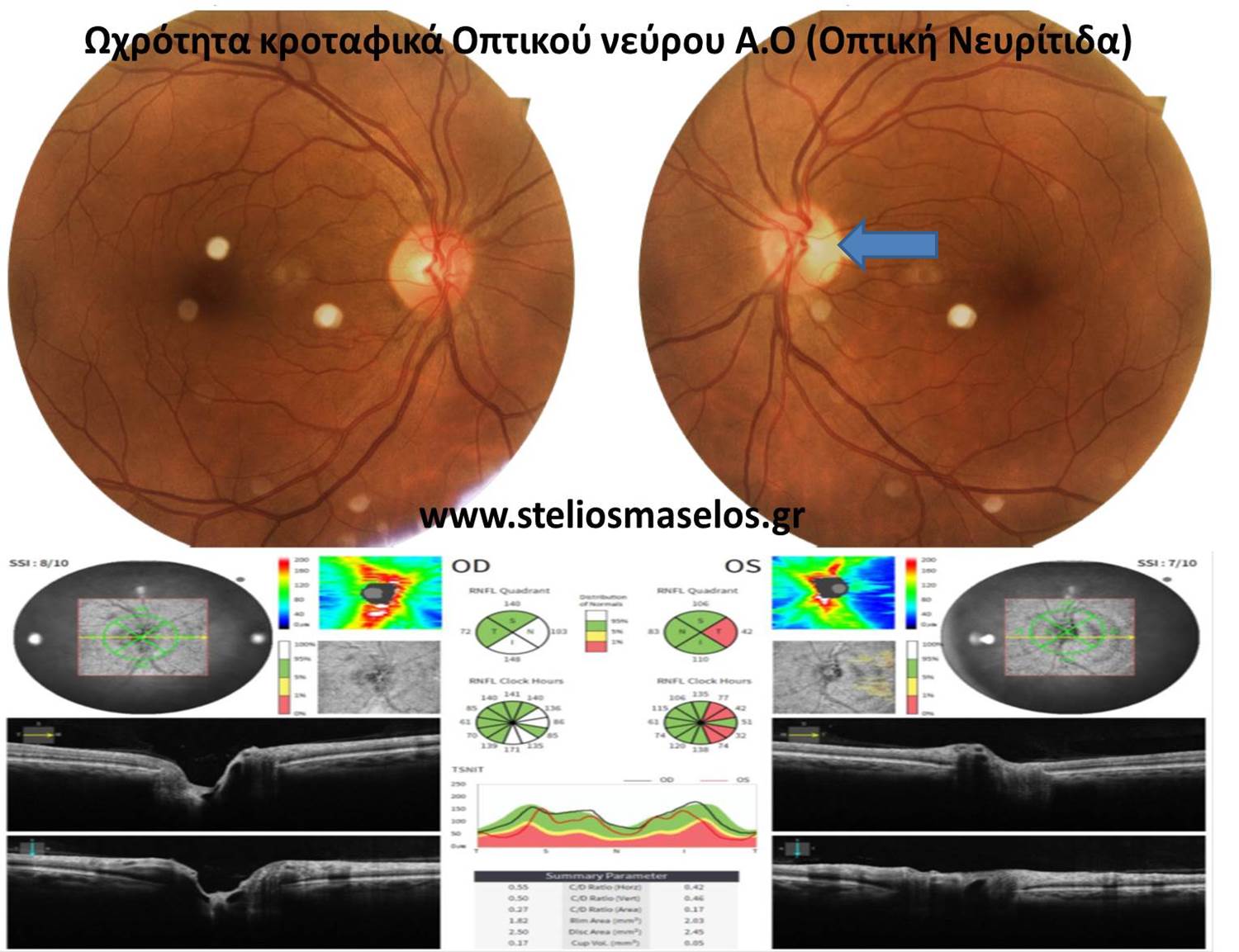 Ωχρότητα κροταφικά Οπτικού νεύρου Α.Ο (Οπτική Νευρίτιδα)