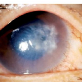 Slit lamp photograph showing M. fortuitum keratitis showing... | Download Scientific Diagram