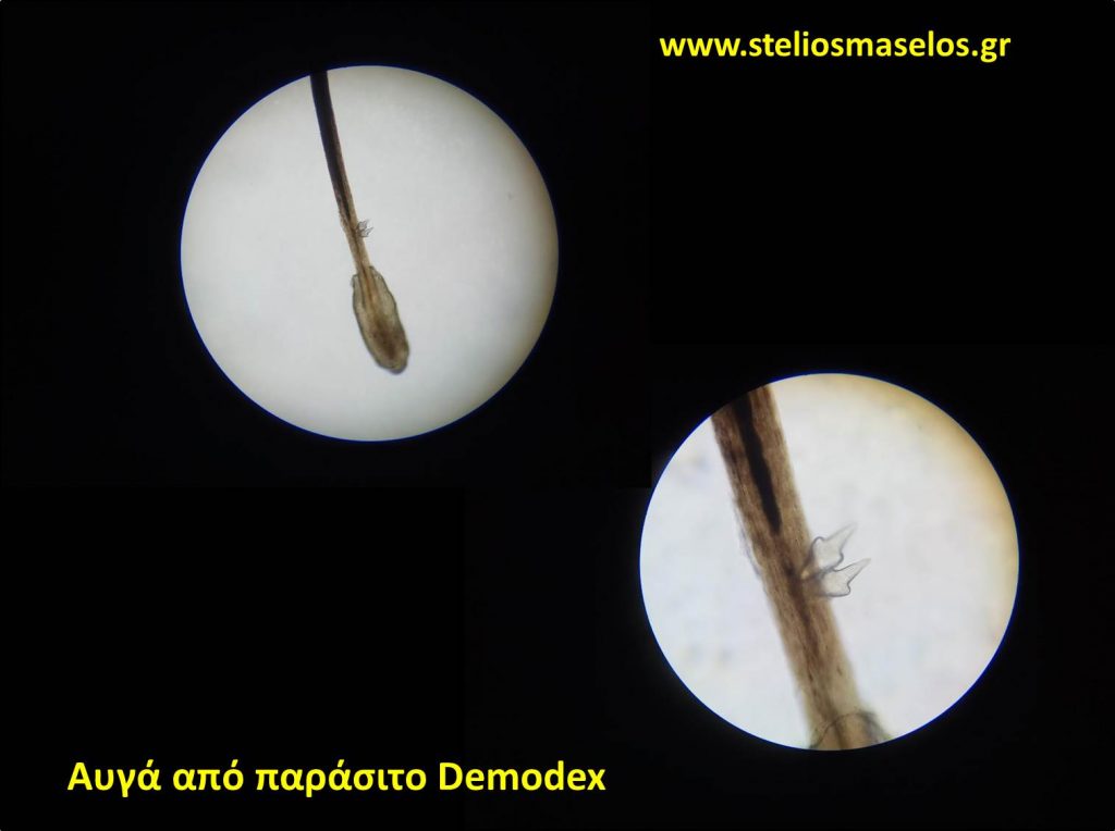 Αυγά από παράσιτο Demodex