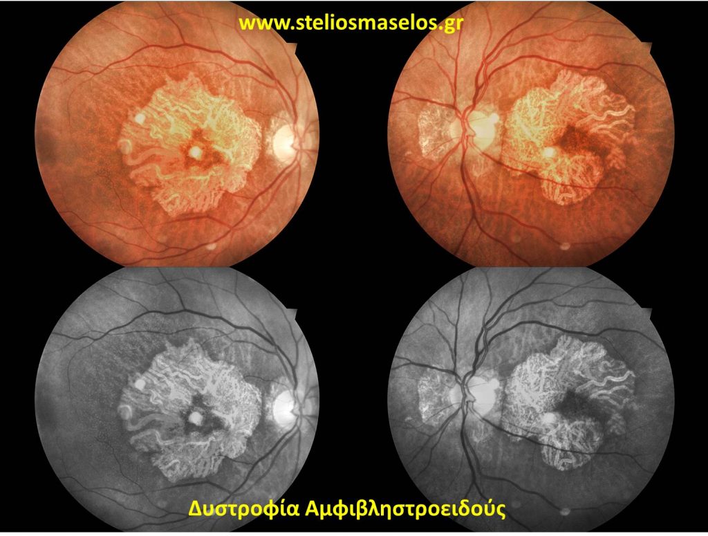 Δυστροφία Αμφιβληστροειδούς