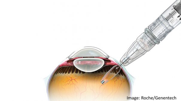 FDA clears Roche’s Susvimo implant for eye disease wet AMD
