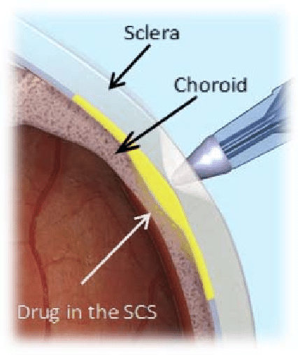 Injection into the suprachoroidal space. | Download Scientific Diagram