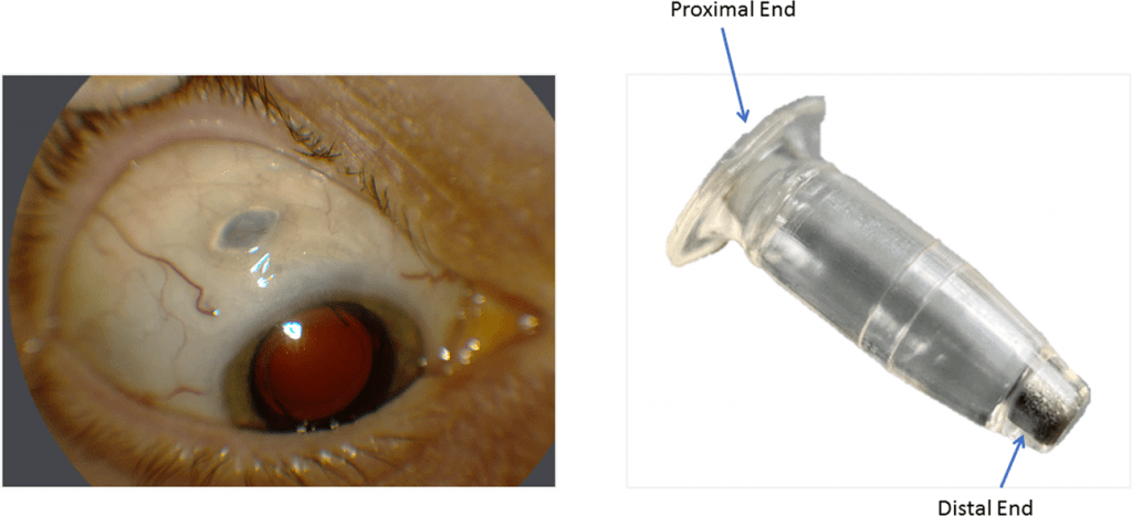 The Port Delivery System with ranibizumab—journey of mitigating vitreous hemorrhage | Eye
