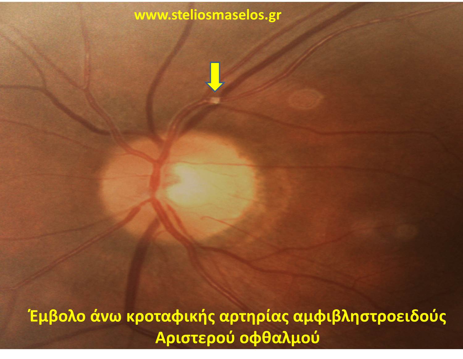 Έμβολο άνω κροταφικής αρτηρίας αμφιβληστροειδούς αριστερού οφθαλμού-